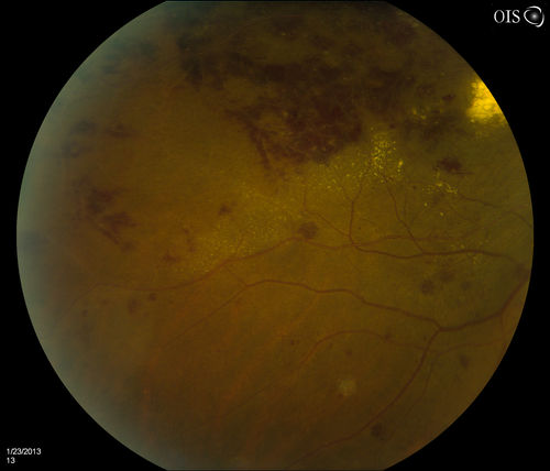 Combined Artery and Vein Occlusion
Patient comes in with decreased vision in both eyes. VA 20/200-OD, 20/60-OS. Fundus exam shows great amount of macular edema due to artery and vein occlusions. There is some neovascularization on the optic nerve in the right eye. Patient was treated with Eylea Injection in the left eye today and will return for Eylea Injection in the right eye.
