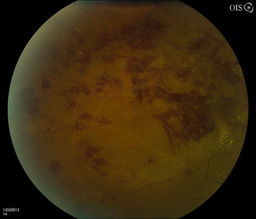 Combined Artery and Vein Occlusion
Patient comes in with decreased vision in both eyes. VA 20/200-OD, 20/60-OS. Fundus exam shows great amount of macular edema due to artery and vein occlusions. There is some neovascularization on the optic nerve in the right eye. Patient was treated with Eylea Injection in the left eye today and will return for Eylea Injection in the right eye.
