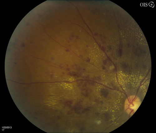 Combined Artery and Vein Occlusion
Patient comes in with decreased vision in both eyes. VA 20/200-OD, 20/60-OS. Fundus exam shows great amount of macular edema due to artery and vein occlusions. There is some neovascularization on the optic nerve in the right eye. Patient was treated with Eylea Injection in the left eye today and will return for Eylea Injection in the right eye.
