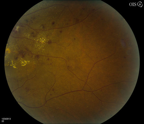 Combined Artery and Vein Occlusion
Patient comes in with decreased vision in both eyes. VA 20/200-OD, 20/60-OS. Fundus exam shows great amount of macular edema due to artery and vein occlusions. There is some neovascularization on the optic nerve in the right eye. Patient was treated with Eylea Injection in the left eye today and will return for Eylea Injection in the right eye.
