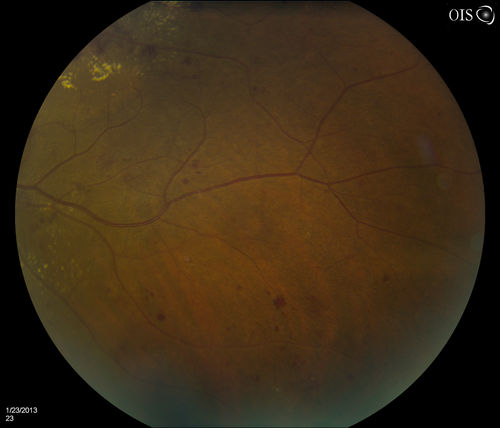 Combined Artery and Vein Occlusion
Patient comes in with decreased vision in both eyes. VA 20/200-OD, 20/60-OS. Fundus exam shows great amount of macular edema due to artery and vein occlusions. There is some neovascularization on the optic nerve in the right eye. Patient was treated with Eylea Injection in the left eye today and will return for Eylea Injection in the right eye.
