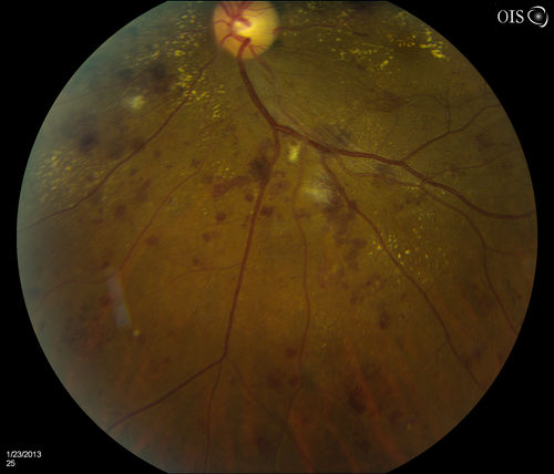 Combined Artery and Vein Occlusion
Patient comes in with decreased vision in both eyes. VA 20/200-OD, 20/60-OS. Fundus exam shows great amount of macular edema due to artery and vein occlusions. There is some neovascularization on the optic nerve in the right eye. Patient was treated with Eylea Injection in the left eye today and will return for Eylea Injection in the right eye.
