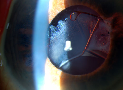 Subluxated Crystalline IOL with Pseudoexfoliation
82-year old male comes in with blurriness on the bottom half of his vision. Patient's VA was 20/25. Slit lamp examination shows subluxated crystalline lens inferiorily. Pseudoexfoliation debris superiorly at 10 o'clock with no vitreous present in the anterior chamber. Patient scheduled for surgery for CE IOL in the right eye. 
