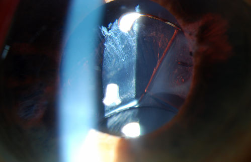 Subluxated Crystalline IOL with Pseudoexfoliation
82-year old male comes in with blurriness on the bottom half of his vision. Patient's VA was 20/25. Slit lamp examination shows subluxated crystalline lens inferiorily. Pseudoexfoliation debris superiorly at 10 o'clock with no vitreous present in the anterior chamber. Patient scheduled for surgery for CE IOL in the right eye. 

