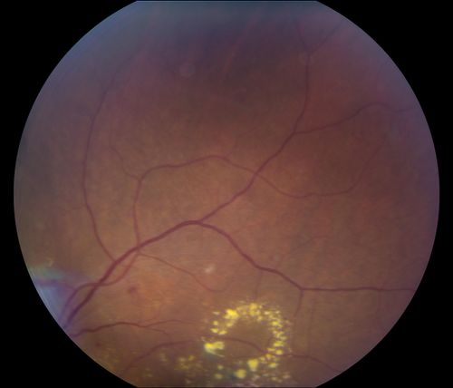 Nonproliferative Diabetic Retinopathy
65-year old female with diabetes. Has had cataract surgery in the left eye with VA 20/25. She has had laser in the past. Fundus examination shows microaneurysms with retinal hemorrahages and exudates in the left eye. 

