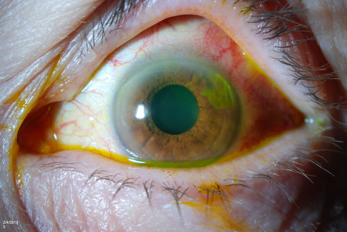 Corneal Abrasion with Foreign Body Present 
ER patient comes in with corneal abrasion in the left eye which was getting worst. VA 20/25. Slit lamp exam showed corneal abrasion superiorly at 2-o'clock. Flipped eyelid and foreign body appeared on the upper tarsal plate. Foreign body was removed. 
