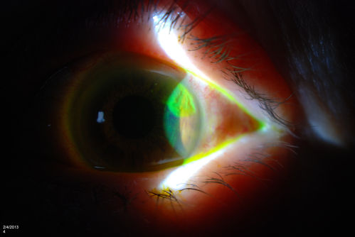 Corneal Abrasion with Foreign Body Present 
ER patient comes in with corneal abrasion in the left eye which was getting worst. VA 20/25. Slit lamp exam showed corneal abrasion superiorly at 2-o'clock. Flipped eyelid and foreign body appeared on the upper tarsal plate. Foreign body was removed. 
