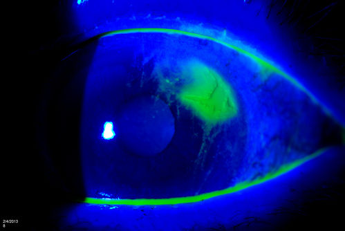 Corneal Abrasion with Foreign Body Present 
ER patient comes in with corneal abrasion in the left eye which was getting worst. VA 20/25. Slit lamp exam showed corneal abrasion superiorly at 2-o'clock. Flipped eyelid and foreign body appeared on the upper tarsal plate. Foreign body was removed. 
