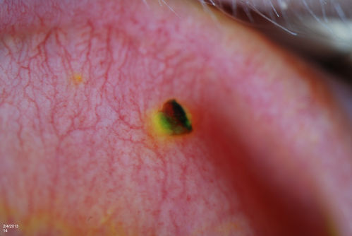 Corneal Abrasion with Foreign Body Present 
ER patient comes in with corneal abrasion in the left eye which was getting worst. VA 20/25. Slit lamp exam showed corneal abrasion superiorly at 2-o'clock. Flipped eyelid and foreign body appeared on the upper tarsal plate. Foreign body was removed. 
Schlüsselwörter: february2013