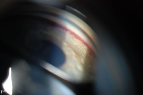 Gonioscopy, Blood in the Anterior Chamber from Hyphema
Patient comes in with blunt trauma to the right eye due to a BB gun incident. Patient was present with a hyphema at 8-o'clock about 1mm thick. Gonioscopy photos were then taken to show blood from the hyphema entered into the anterior chamber. Patient had no angle recession in the right eye.  
