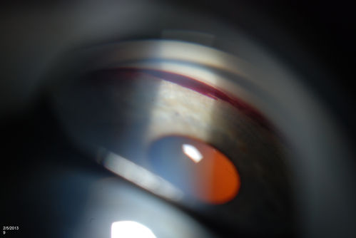 Gonioscopy, Blood in the Anterior Chamber from Hyphema
Patient comes in with blunt trauma to the right eye due to a BB gun incident. Patient was present with a hyphema at 8-o'clock about 1mm thick. Gonioscopy photos were then taken to show blood from the hyphema entered into the anterior chamber. Patient had no angle recession in the right eye.  
Keywords: february2013