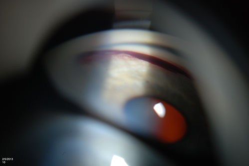 Gonioscopy, Blood in the Anterior Chamber from Hyphema
Patient comes in with blunt trauma to the right eye due to a BB gun incident. Patient was present with a hyphema at 8-o'clock about 1mm thick. Gonioscopy photos were then taken to show blood from the hyphema entered into the anterior chamber. Patient had no angle recession in the right eye.  

