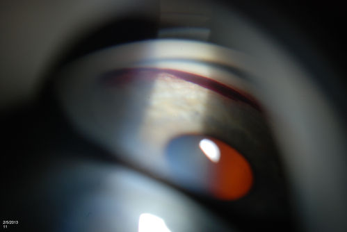 Gonioscopy, Blood in the Anterior Chamber from Hyphema
Patient comes in with blunt trauma to the right eye due to a BB gun incident. Patient was present with a hyphema at 8-o'clock about 1mm thick. Gonioscopy photos were then taken to show blood from the hyphema entered into the anterior chamber. Patient had no angle recession in the right eye.  
