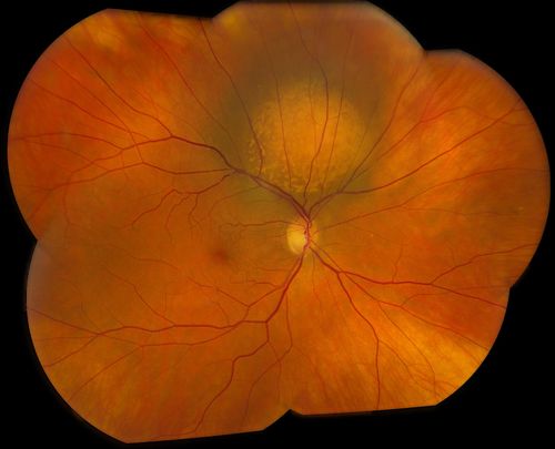 Choroidal Metastasis Tumor 
Patient that a history of breast cancer. She has a metastasis tumor superiority in the right eye. VA was 20/20, right eye. Patient underwent radiation and chemotherapy and mass has not changed in size for the past year. 
Keywords: july2013