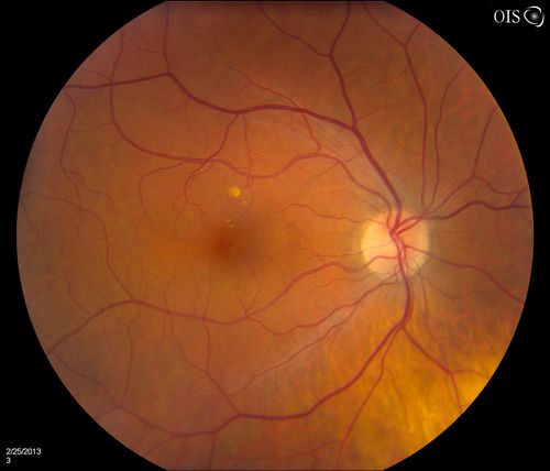 Pigmented Peripheral Retinal Degeneration
42-year old male comes in for routine eye exam and to follow up on peripheral retinal degeneration in both eyes. VA is 20/20, right eye and 20/25, left eye. Patient is asymptomatic with no visual complaints.
