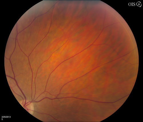 Pigmented Peripheral Retinal Degeneration
42-year old male comes in for routine eye exam and to follow up on peripheral retinal degeneration in both eyes. VA is 20/20, right eye and 20/25, left eye. Patient is asymptomatic with no visual complaints.
