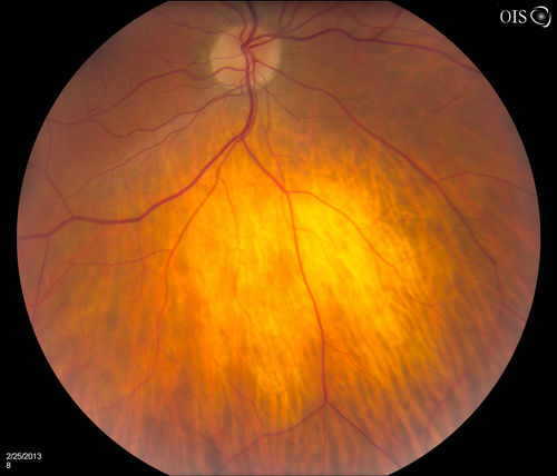 Pigmented Peripheral Retinal Degeneration
42-year old male comes in for routine eye exam and to follow up on peripheral retinal degeneration in both eyes. VA is 20/20, right eye and 20/25, left eye. Patient is asymptomatic with no visual complaints.
