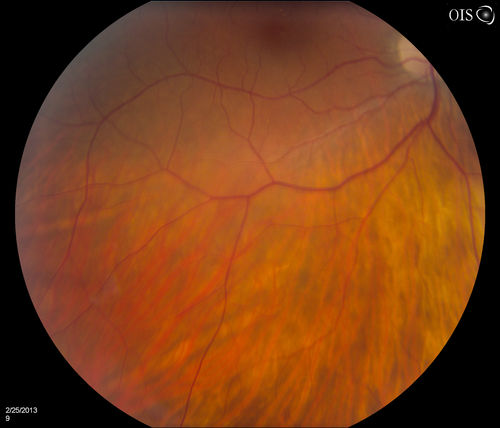 Pigmented Peripheral Retinal Degeneration
42-year old male comes in for routine eye exam and to follow up on peripheral retinal degeneration in both eyes. VA is 20/20, right eye and 20/25, left eye. Patient is asymptomatic with no visual complaints.
