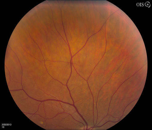 Pigmented Peripheral Retinal Degeneration
42-year old male comes in for routine eye exam and to follow up on peripheral retinal degeneration in both eyes. VA is 20/20, right eye and 20/25, left eye. Patient is asymptomatic with no visual complaints.
