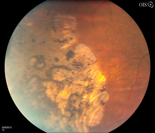 Pigmented Peripheral Retinal Degeneration
42-year old male comes in for routine eye exam and to follow up on peripheral retinal degeneration in both eyes. VA is 20/20, right eye and 20/25, left eye. Patient is asymptomatic with no visual complaints.
