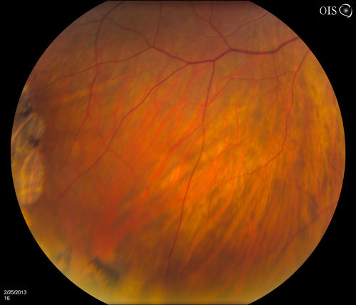 Pigmented Peripheral Retinal Degeneration
42-year old male comes in for routine eye exam and to follow up on peripheral retinal degeneration in both eyes. VA is 20/20, right eye and 20/25, left eye. Patient is asymptomatic with no visual complaints.
