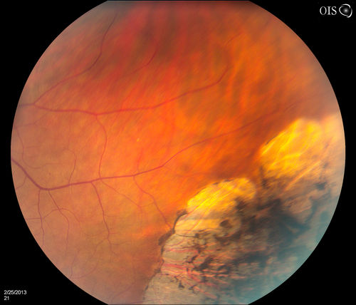 Pigmented Peripheral Retinal Degeneration
42-year old male comes in for routine eye exam and to follow up on peripheral retinal degeneration in both eyes. VA is 20/20, right eye and 20/25, left eye. Patient is asymptomatic with no visual complaints.
