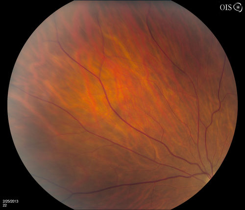Pigmented Peripheral Retinal Degeneration
42-year old male comes in for routine eye exam and to follow up on peripheral retinal degeneration in both eyes. VA is 20/20, right eye and 20/25, left eye. Patient is asymptomatic with no visual complaints.
