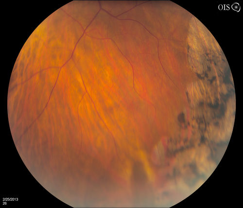 Pigmented Peripheral Retinal Degeneration
42-year old male comes in for routine eye exam and to follow up on peripheral retinal degeneration in both eyes. VA is 20/20, right eye and 20/25, left eye. Patient is asymptomatic with no visual complaints.
