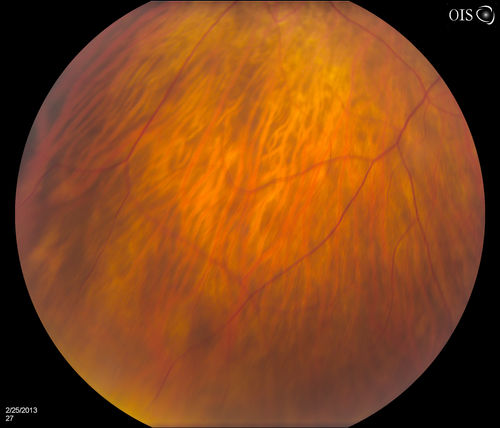 Pigmented Peripheral Retinal Degeneration
42-year old male comes in for routine eye exam and to follow up on peripheral retinal degeneration in both eyes. VA is 20/20, right eye and 20/25, left eye. Patient is asymptomatic with no visual complaints.

