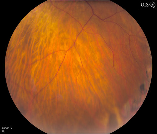 Pigmented Peripheral Retinal Degeneration
42-year old male comes in for routine eye exam and to follow up on peripheral retinal degeneration in both eyes. VA is 20/20, right eye and 20/25, left eye. Patient is asymptomatic with no visual complaints.
