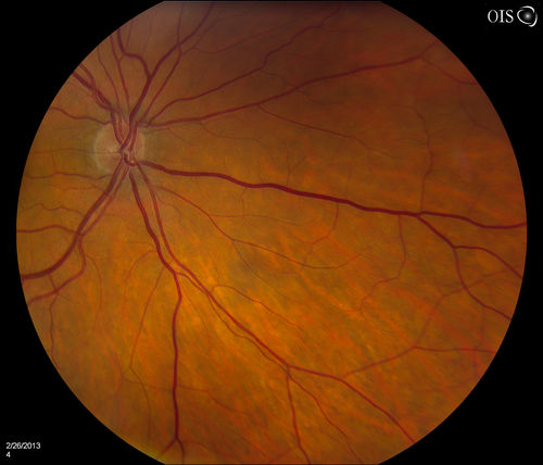 Uveal Choroidal Melanoma
Patient comes in for evaluation on a Choroidal Melanoma in the right eye. VA was 20/25 in both eyes. The melanoma is in the temporal aspect of the right eye. It measured at 0.7mm elevated after doing a BSCAN Ultrasound. 

