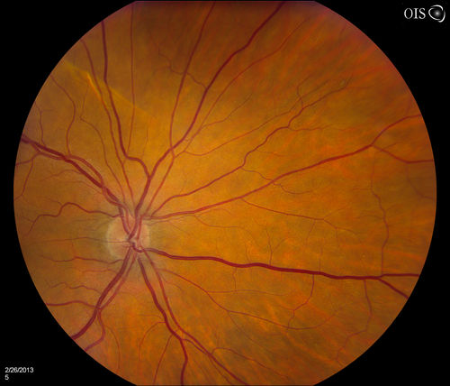 Uveal Choroidal Melanoma
Patient comes in for evaluation on a Choroidal Melanoma in the right eye. VA was 20/25 in both eyes. The melanoma is in the temporal aspect of the right eye. It measured at 0.7mm elevated after doing a BSCAN Ultrasound. 
