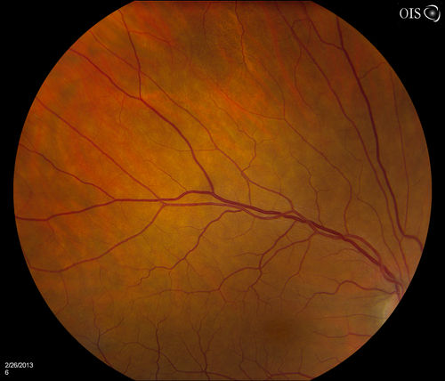 Uveal Choroidal Melanoma
Patient comes in for evaluation on a Choroidal Melanoma in the right eye. VA was 20/25 in both eyes. The melanoma is in the temporal aspect of the right eye. It measured at 0.7mm elevated after doing a BSCAN Ultrasound. 
