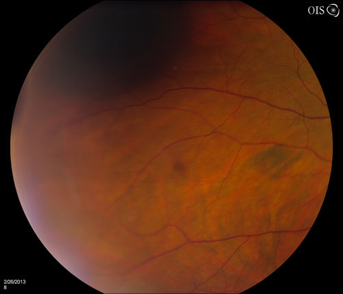 Uveal Choroidal Melanoma
Patient comes in for evaluation on a Choroidal Melanoma in the right eye. VA was 20/25 in both eyes. The melanoma is in the temporal aspect of the right eye. It measured at 0.7mm elevated after doing a BSCAN Ultrasound. 
