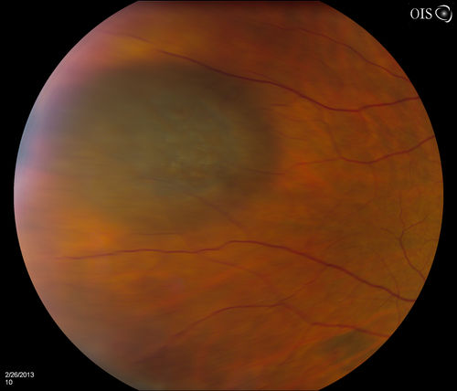 Uveal Choroidal Melanoma
Patient comes in for evaluation on a Choroidal Melanoma in the right eye. VA was 20/25 in both eyes. The melanoma is in the temporal aspect of the right eye. It measured at 0.7mm elevated after doing a BSCAN Ultrasound. 
