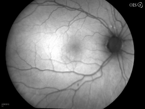 Uveal Choroidal Melanoma
Patient comes in for evaluation on a Choroidal Melanoma in the right eye. VA was 20/25 in both eyes. The melanoma is in the temporal aspect of the right eye. It measured at 0.7mm elevated after doing a BSCAN Ultrasound. 
