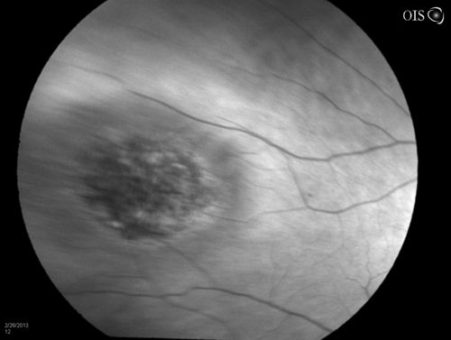 Uveal Choroidal Melanoma
Patient comes in for evaluation on a Choroidal Melanoma in the right eye. VA was 20/25 in both eyes. The melanoma is in the temporal aspect of the right eye. It measured at 0.7mm elevated after doing a BSCAN Ultrasound. 
