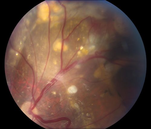 Retinal Capillary Hemangioma due to Von Hipple-Lindau Syndrome
A 47-year old female comes in for a second opinion for retinal capillary Hemangioma in the left eye. VA was HM (hand motion) in the left eye. She has had multiple procedures done for the left eye including, Retinal Detachment surgery, YAG Laser PI, YAG Laser Capsulotomy, and Cataract surgery. 
