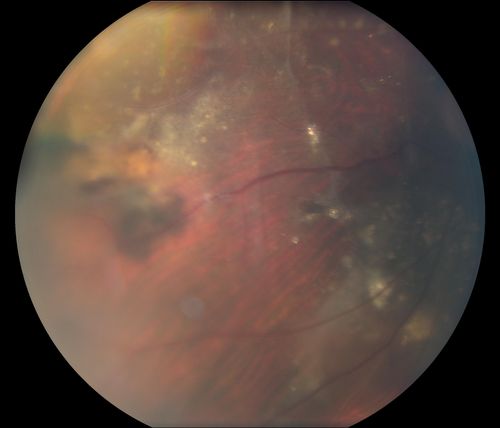 Retinal Capillary Hemangioma due to Von Hipple-Lindau Syndrome
A 47-year old female comes in for a second opinion for retinal capillary Hemangioma in the left eye. VA was HM (hand motion) in the left eye. She has had multiple procedures done for the left eye including, Retinal Detachment surgery, YAG Laser PI, YAG Laser Capsulotomy, and Cataract surgery. 
