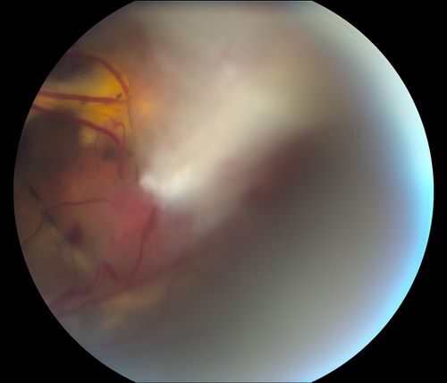 Retinal Capillary Hemangioma due to Von Hipple-Lindau Syndrome
A 47-year old female comes in for a second opinion for retinal capillary Hemangioma in the left eye. VA was HM (hand motion) in the left eye. She has had multiple procedures done for the left eye including, Retinal Detachment surgery, YAG Laser PI, YAG Laser Capsulotomy, and Cataract surgery. 
