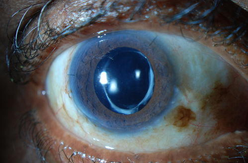 Accordioning Crystalline Lens with loss of Posterior Capsule
71-year old male complains of blurred vision in the left eye. VA 20/40, right eye and 20/400, left eye without correction. Slit lamp exam shows Crystalline lens, both eyes. Right eye IOL is aligned and centered. Left eye shows an accordion of the crystalline lens. Retro Illumination shows the IOL bent inward in the left eye. There was a 6-diopter difference of astigmatism between the right and left eye. Patient will have surgery to correct the issue. 
