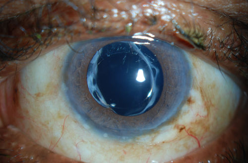 Accordioning Crystalline Lens with loss of Posterior Capsule
71-year old male complains of blurred vision in the left eye. VA 20/40, right eye and 20/400, left eye without correction. Slit lamp exam shows Crystalline lens, both eyes. Right eye IOL is aligned and centered. Left eye shows an accordion of the crystalline lens. Retro Illumination shows the IOL bent inward in the left eye. There was a 6-diopter difference of astigmatism between the right and left eye. Patient will have surgery to correct the issue. 
