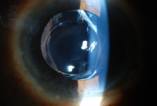 Accordioning Crystalline Lens with loss of Posterior Capsule
71-year old male complains of blurred vision in the left eye. VA 20/40, right eye and 20/400, left eye without correction. Slit lamp exam shows Crystalline lens, both eyes. Right eye IOL is aligned and centered. Left eye shows an accordion of the crystalline lens. Retro Illumination shows the IOL bent inward in the left eye. There was a 6-diopter difference of astigmatism between the right and left eye. Patient will have surgery to correct the issue. 
