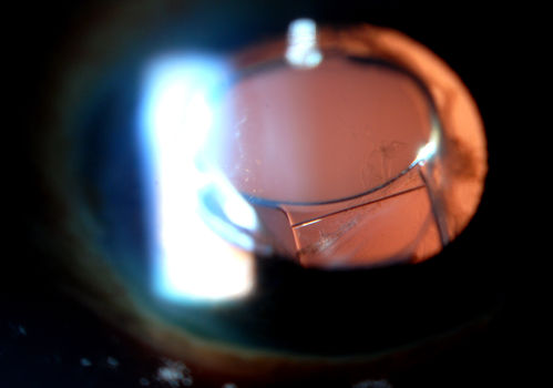 Accordioning Crystalline Lens with loss of Posterior Capsule
71-year old male complains of blurred vision in the left eye. VA 20/40, right eye and 20/400, left eye without correction. Slit lamp exam shows Crystalline lens, both eyes. Right eye IOL is aligned and centered. Left eye shows an accordion of the crystalline lens. Retro Illumination shows the IOL bent inward in the left eye. There was a 6-diopter difference of astigmatism between the right and left eye. Patient will have surgery to correct the issue. 
Keywords: march2013