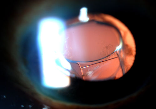 Accordioning Crystalline Lens with loss of Posterior Capsule
71-year old male complains of blurred vision in the left eye. VA 20/40, right eye and 20/400, left eye without correction. Slit lamp exam shows Crystalline lens, both eyes. Right eye IOL is aligned and centered. Left eye shows an accordion of the crystalline lens. Retro Illumination shows the IOL bent inward in the left eye. There was a 6-diopter difference of astigmatism between the right and left eye. Patient will have surgery to correct the issue. 
