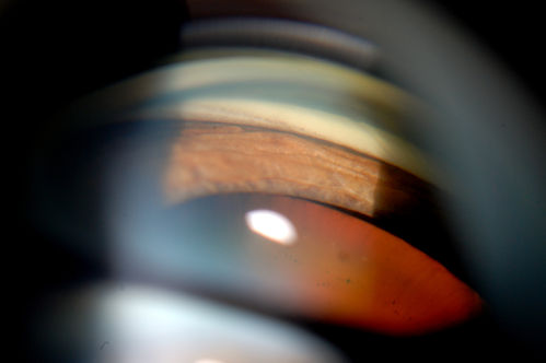 Gonioscopy; Scattered Peripheral Anterior Synechiae
Patient comes in for evaluation for glaucoma. Patient also has a history of Uveitis. Last flare up was back in 1990. Patient's VA was 20/30, Right eye and 20/40-1, Left eye. Slit Lamp Gonioscopy reveals iris bow with scattered PAS around the angles of the anterior chamber. You can also see pigmentation in the trabecular meshwork. Patient will follow up in 3-months.  
