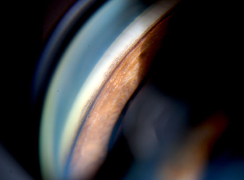 Gonioscopy; Scattered Peripheral Anterior Synechiae
Patient comes in for evaluation for glaucoma. Patient also has a history of Uveitis. Last flare up was back in 1990. Patient's VA was 20/30, Right eye and 20/40-1, Left eye. Slit Lamp Gonioscopy reveals iris bow with scattered PAS around the angles of the anterior chamber. You can also see pigmentation in the trabecular meshwork. Patient will follow up in 3-months.  
