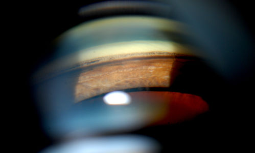 Gonioscopy; Scattered Peripheral Anterior Synechiae
Patient comes in for evaluation for glaucoma. Patient also has a history of Uveitis. Last flare up was back in 1990. Patient's VA was 20/30, Right eye and 20/40-1, Left eye. Slit Lamp Gonioscopy reveals iris bow with scattered PAS around the angles of the anterior chamber. You can also see pigmentation in the trabecular meshwork. Patient will follow up in 3-months.  
