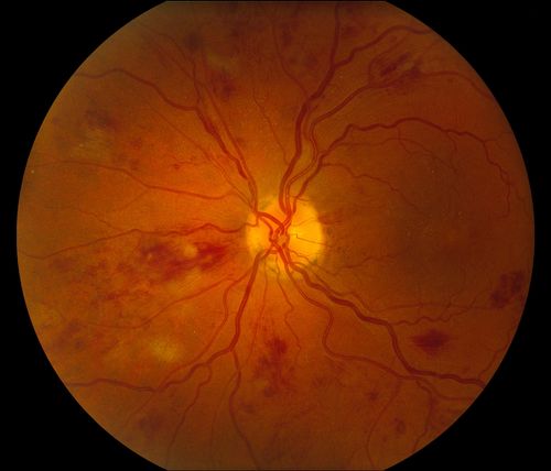 BRVO Inferiorly with Retinal Hemorrhages in the Left Eye
Patient comes in with complaint of "spot in vision", sort of a cloudy haze in the left eye. Patient's VA was 20/100-1 with no improvement with pinhole in the left eye. Fundus photos show multiple retinal hemorrhages scattered with a branch retinal vein occlusion inferiorily. Patient is also diabetic.
