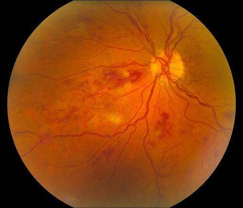 BRVO Inferiorly with Retinal Hemorrhages in the Left Eye
Patient comes in with complaint of "spot in vision", sort of a cloudy haze in the left eye. Patient's VA was 20/100-1 with no improvement with pinhole in the left eye. Fundus photos show multiple retinal hemorrhages scattered with a branch retinal vein occlusion inferiorily. Patient is also diabetic.
